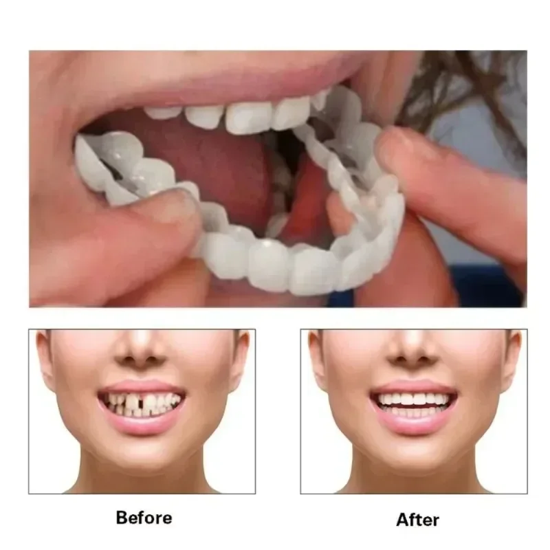 Teeth Whitening Device - Teeth Whitening Cover Snap on Silicone