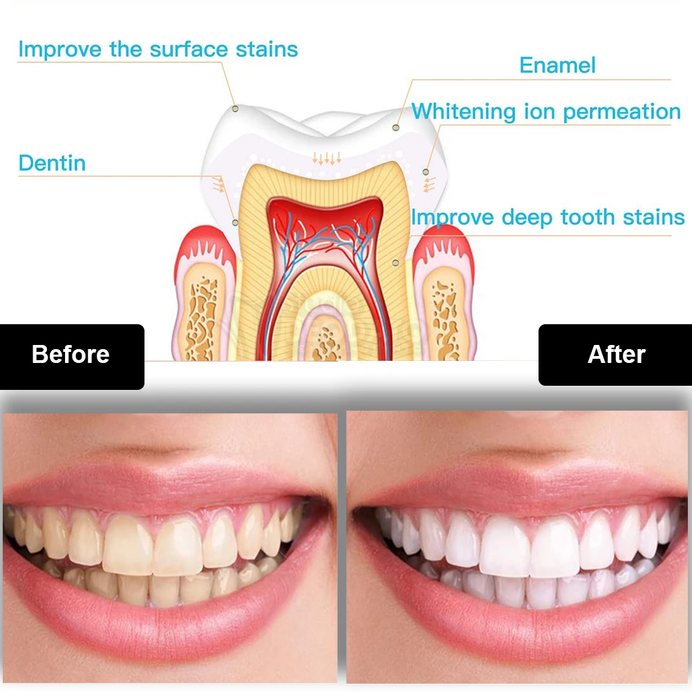 Dental Teeth Whitening Kit Min - Teeth Whitening Device 리뷰 및 가격